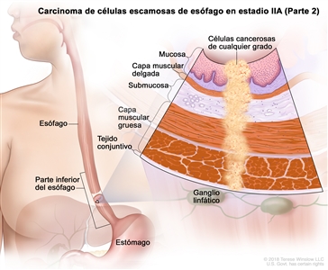 Carcinoma de células escamosas de esófago en estadio IIA (Parte 2). En la imagen se observan el esófago, incluso la parte inferior del esófago, y el estómago. En una ampliación, se muestran células cancerosas de cualquier grado en la mucosa, la capa muscular delgada, la submucosa, la capa muscular gruesa y el tejido conjuntivo de la pared de la parte inferior del esófago. También se muestran ganglios linfáticos.