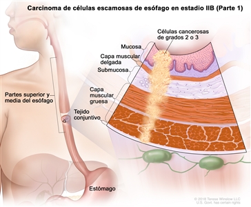Carcinoma de células escamosas de esófago en estadio IIB (Parte 1). En la imagen se observan las partes superior y media del esófago, y el estómago. En una ampliación, se muestran células cancerosas en la mucosa, la capa muscular delgada, la submucosa, la capa muscular gruesa y el tejido conjuntivo de las partes superior y media de la pared del esófago. Las células cancerosas son de grados 2 o 3.