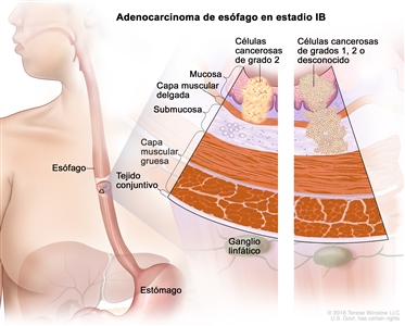 Adenocarcinoma de esófago en estadio IB. En la imagen se observan el esófago y el estómago. En una ampliación con dos paneles, se muestran las capas de la pared del esófago: la mucosa, la capa muscular delgada, la submucosa, la capa muscular gruesa y el tejido conjuntivo. También se muestran ganglios linfáticos. En el panel izquierdo, se observan células cancerosas de grado 2 en la mucosa y la capa muscular delgada. En el panel derecho, se observan células cancerosas en la mucosa, la capa muscular delgada y la submucosa; las células cancerosas son de grado 1, grado 2 o grado desconocido.