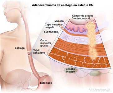 Adenocarcinoma de esófago en estadio IIA. En la imagen se observan el esófago y el estómago. En una ampliación, se muestran células cancerosas en la mucosa, la capa muscular delgada, la submucosa y la capa muscular gruesa de la pared del esófago. Las células cancerosas son de grado 3 o grado desconocido. También se muestran la capa de tejido conjuntivo de la pared del esófago y ganglios linfáticos.
