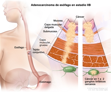 Adenocarcinoma de esófago en estadio IIB. En la imagen se observan el esófago y el estómago. En una ampliación con dos paneles, se muestran las capas de la pared del esófago: la mucosa, la capa muscular delgada, la submucosa, la capa muscular gruesa y el tejido conjuntivo. En el panel izquierdo, se observa cáncer en la mucosa, la capa muscular delgada, la submucosa, la capa muscular gruesa y el tejido conjuntivo. En el panel derecho, se observa cáncer en la mucosa, la capa muscular delgada, la submucosa y en 1 ganglio linfático cercano.