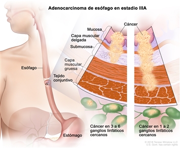 Adenocarcinoma de esófago en estadio IIIA. En la imagen se observan el esófago y el estómago. En una ampliación con dos paneles, se muestran las capas de la pared del esófago: la mucosa, la capa muscular delgada, la submucosa, la capa muscular gruesa y el tejido conjuntivo. En el panel izquierdo, se observa cáncer en la mucosa, la capa muscular delgada, la submucosa y en 3 ganglios linfáticos cercanos. En el panel derecho, se observa cáncer en la mucosa, la capa muscular delgada, la submucosa, la capa muscular gruesa y en 1 ganglio linfático cercano.