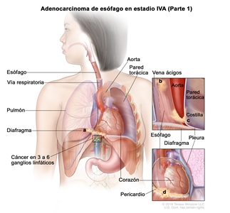 Adenocarcinoma de esófago en estadio IVA (Parte 1). En la imagen se observa cáncer en el esófago y en los siguientes sitios: a) el diafragma, b) la vena ácigos, c) la pleura y d) el pericardio. También se muestra cáncer en 3 ganglios linfáticos cercanos. Además, se observan la vía respiratoria, el pulmón, la aorta, la pared torácica, el corazón y una costilla.
