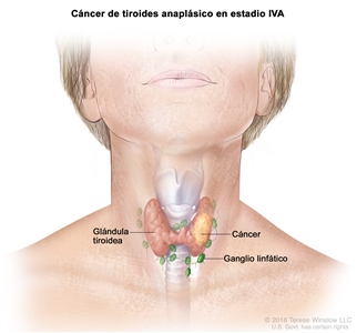 Cáncer de tiroides anaplásico en estadio IVA. En la imagen se muestra el cáncer en la glándula tiroidea. También se muestran los ganglios linfáticos.
