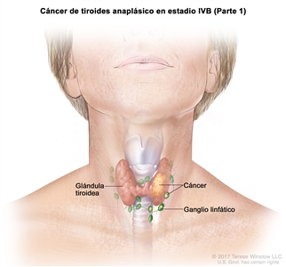 Cáncer de tiroides anaplásico en estadio IVB (Parte 1). En la imagen se muestra el cáncer en la glándula tiroidea y los ganglios linfáticos cercanos.