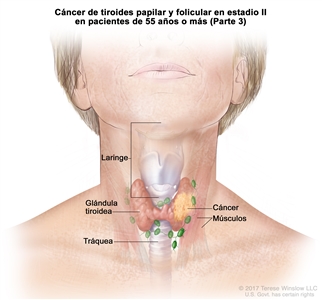 Cáncer de tiroides papilar y folicular en estadio II en pacientes de 55 años o más (Parte 3). En la imagen se muestran el cáncer en la glándula tiroidea y los músculos cercanos del cuello. También se muestran la laringe y la tráquea.