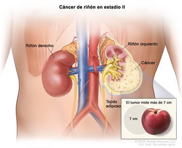 Cáncer de riñón en estadio II; en la ilustración se muestra cáncer en el riñón izquierdo y que el tumor mide más de 7 cm. En el recuadro se muestra que 7 cm es casi el tamaño de un durazno. También se observa el tejido adiposo y el riñón derecho.