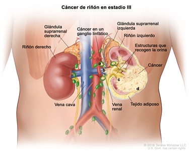 Cáncer de riñón en estadio III; en la ilustración se muestra cáncer en el riñón izquierdo y en: a) los ganglios linfáticos cercanos, b) la vena renal, c) las estructuras que recogen la orina y d) la capa de tejido adiposo que rodea el riñón. También se muestra el riñón derecho, la vena cava y las glándulas suprarrenales izquierda y derecha.