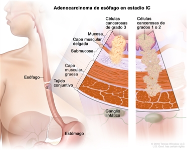 Adenocarcinoma de esófago en estadio IC. En la imagen se observan el esófago y el estómago. En una ampliación con dos paneles, se muestran las capas de la pared del esófago: la mucosa, la capa muscular delgada, la submucosa, la capa muscular gruesa y el tejido conjuntivo. También se muestran ganglios linfáticos. En el panel izquierdo, se observan células cancerosas de grado 3 en la mucosa, la capa muscular delgada y la submucosa. En el panel derecho, se observan células cancerosas de grados 1 o 2 en la mucosa, la capa muscular delgada, la submucosa y la capa muscular gruesa.
