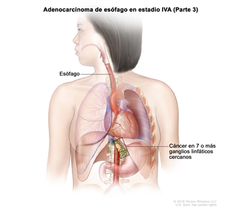 Adenocarcinoma de esófago en estadio IVA (Parte 3). En la imagen se observa cáncer en el esófago y en 9 ganglios linfáticos cercanos.
