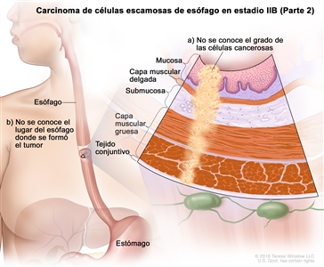 Carcinoma de células escamosas de esófago en estadio IIB (Parte 2). En la imagen se observan el esófago y el estómago. En una ampliación se muestra lo siguiente: a) no se conoce el grado de las células cancerosas en la mucosa, la capa muscular delgada, la submucosa, la capa muscular gruesa y el tejido conectivo de la pared del esófago; b) no se conoce el lugar del esófago donde se formó el tumor.