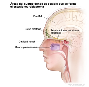 En la imagen se observan las áreas del cuerpo donde es posible que se formen tumores del estesioneuroblastoma, como las terminaciones nerviosas olfatorias, el bulbo olfatorio, la cavidad nasal, los senos paranasales y el encéfalo.