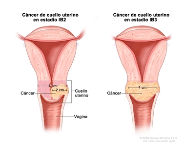 Cáncer de cuello uterino en estadios IB2 y IB3. En la imagen se observan dos cortes transversales del cuello uterino y la vagina. En la imagen de la izquierda se muestra cáncer de cuello uterino en estadio IB2, y el tumor mide más de 2 cm, pero no más de 4 cm. En la imagen de la derecha se muestra cáncer de cuello uterino en estadio IB3, y el tumor mide más de 4 cm.