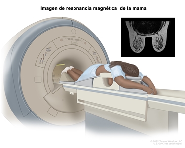 Imagen por resonancia magnética (IRM) de la mama. En la imagen se observa una persona acostada boca abajo en una camilla estrecha y acolchada. La persona tiene los brazos estirados por encima de la cabeza y las mamas cuelgan dentro de un orificio en la camilla. La camilla se desliza en la máquina de IRM y se crean imágenes detalladas del interior de las mamas. En un recuadro se observa una imagen de IRM del interior de ambas mamas.