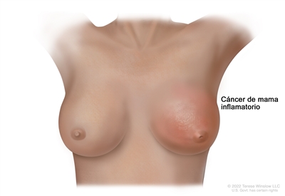 Cáncer de mama inflamatorio. Se observa que en la mama izquierda hay enrojecimiento y piel de naranja, y el pezón está invertido.