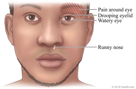 Cluster-Kopfschmerzen (cluster headaches)