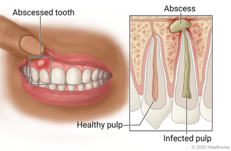 Mouth with abscessed tooth and pocket of pus in gums near it, with inside detail of tooth with healthy pulp and abscessed tooth with infected pulp