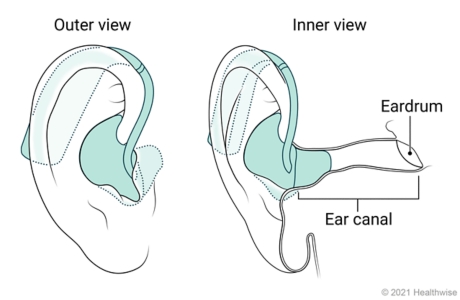 Outer and inner view of behind-the-ear hearing aid placed in ear.