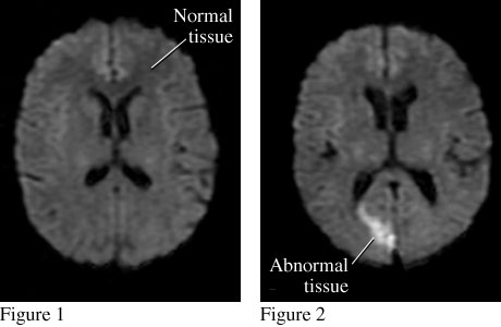 MRI images of a stroke MRI