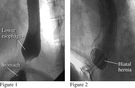 X-ray images after a barium swallow showing a normal esophagus and an esophagus with a hiatal hernia