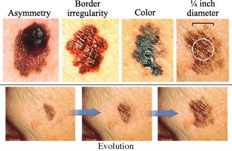 Photos of various melanoma, showing one with asymmetry, one with border irregularity, one with varied color, and one larger than ¼ inch, and three images showing evolution of size of melanoma.