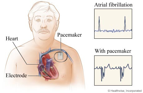 Location of pacemaker in chest, with before-and-after EKG results.