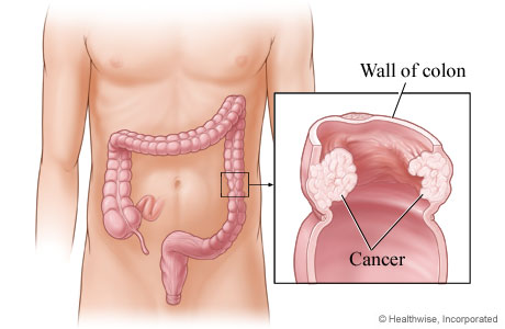 Cancer in the wall of the descending colon