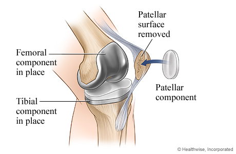 Knee replacement surgery: Patellar component