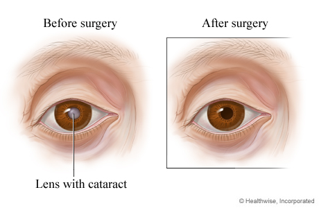 How the eye looks before and after cataract surgery