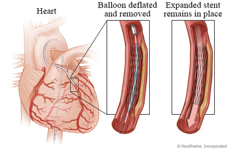Deflated balloon leaving an expanded stent in place