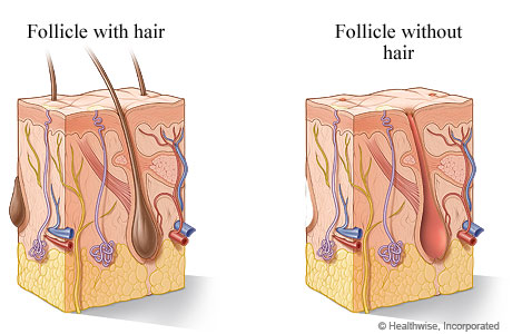 Hair follicle with hair and without hair