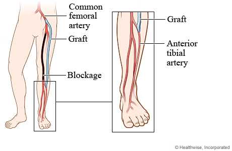 Blocked artery and position of graft in femoral-tibial bypass surgery