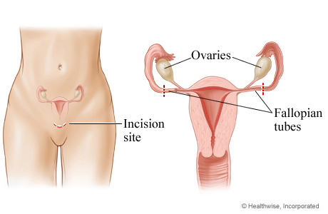 Picture of mini-laparotomy for female sterilization