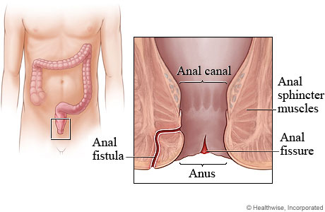 Picture of anal fissure and anal fistula