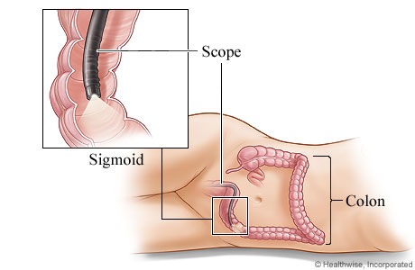 Sigmoidoscope in the sigmoid colon