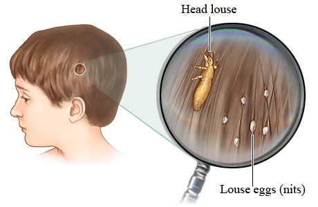 The most horrific case of head lice these experts have ever seen