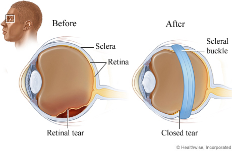A retinal tear and a scleral buckle