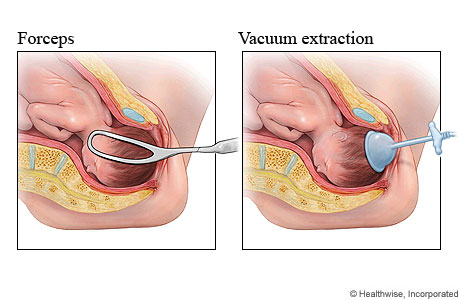 Forceps and vacuum extraction methods for assisted delivery of a baby