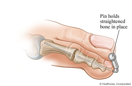 Pin holding the straightened bone in place