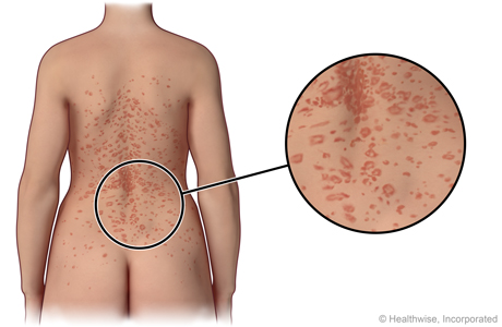 Pityriasis rosea on the back, with close-up of the rash.
