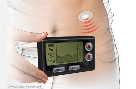 Continuous glucose monitor