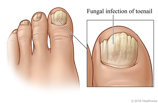 Toenails showing typical symptoms of the most common fungal nail infection, with close-up of big toe