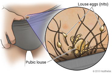 Pubic lice in top band of underwear, with close-up of louse and eggs (nits)