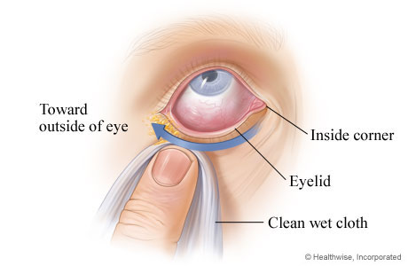 How to clean an eye