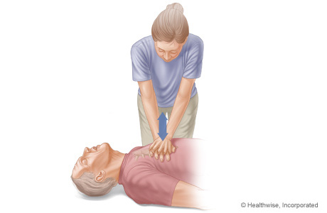 CPR on adult, showing arm and body positions for doing chest compressions
