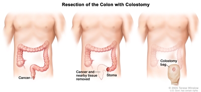 Three-panel drawing showing anal cancer surgery with colostomy; first panel shows area of anus with cancer, middle panel shows cancer and nearby tissue removed and stoma created, last panel shows a colostomy bag attached to the stoma.