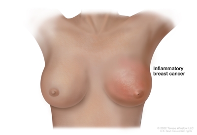 Inflammatory breast cancer of the left breast with redness, peau d'orange, and inverted nipple.