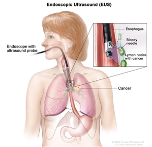 Endoscopic ultrasound-guided fine-needle aspiration biopsy; drawing shows an endoscope with an ultrasound probe and biopsy needle inserted through the mouth and into the esophagus. Drawing also shows lymph nodes near the esophagus and cancer in one lung. Inset shows the ultrasound probe locating the lymph nodes with cancer and the biopsy needle removing tissue from one of the lymph nodes near the esophagus.