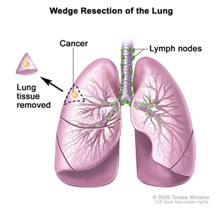 Wedge resection of the lung; shows trachea and lungs with cancer in a lung lobe. The removed lung tissue with the cancer and small amount of healthy tissue around it is shown next to the lung lobe it was removed from.