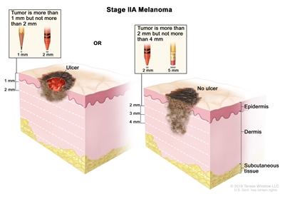 Two-panel drawing of stage IIA melanoma; the panel on the left shows a tumor that is more than 1 but not more than 2 millimeters thick, with ulceration (a break in the skin). The panel on the right shows a tumor that is more than 2 but not more than 4 millimeters thick, without ulceration. Also shown are the epidermis (outer layer of the skin), the dermis (inner layer of the skin), and the subcutaneous tissue below the dermis.